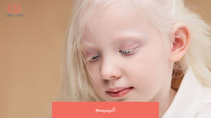 آلبینیسم (Albinism)