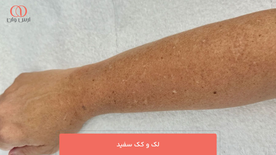 لک و کک سفید (Idiopathic Guttate Hypomelanosis)