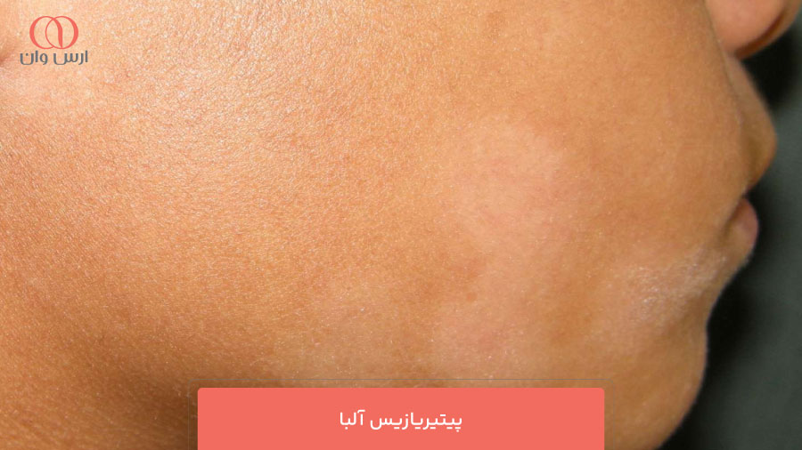 پیتیریازیس آلبا